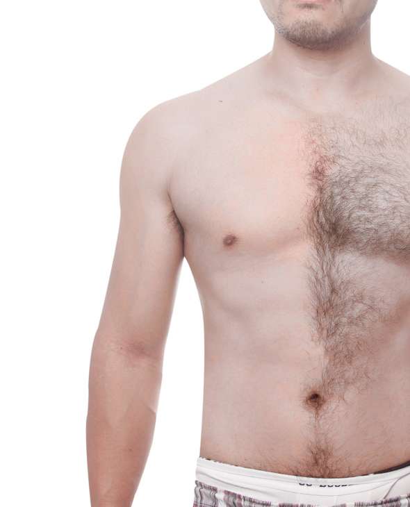 Laser Hair Removal, Man With Removed Hair and With Hair Partial