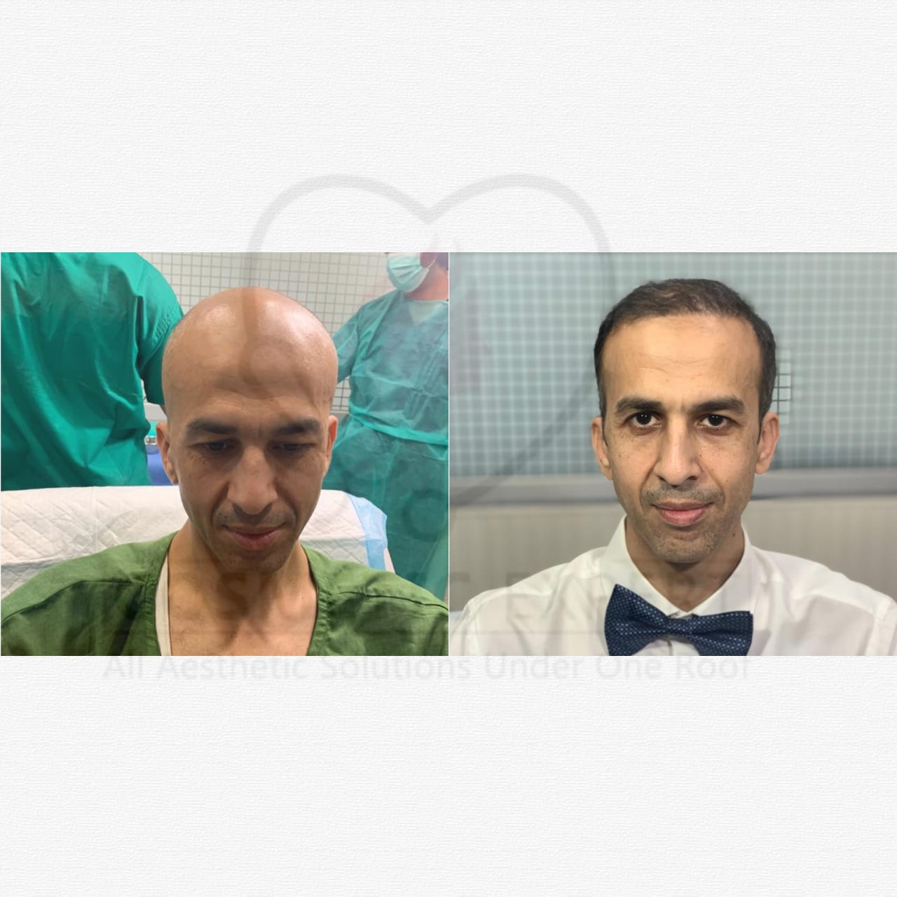 Hair transplant in peshawar, hair trannsplat before and after
