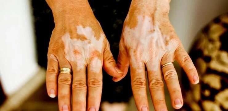 Vitiligo, Phulbehri Treatment in Peshawar