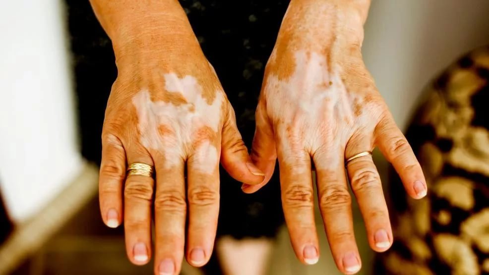 Vitiligo, Phulbehri Treatment in Peshawar
