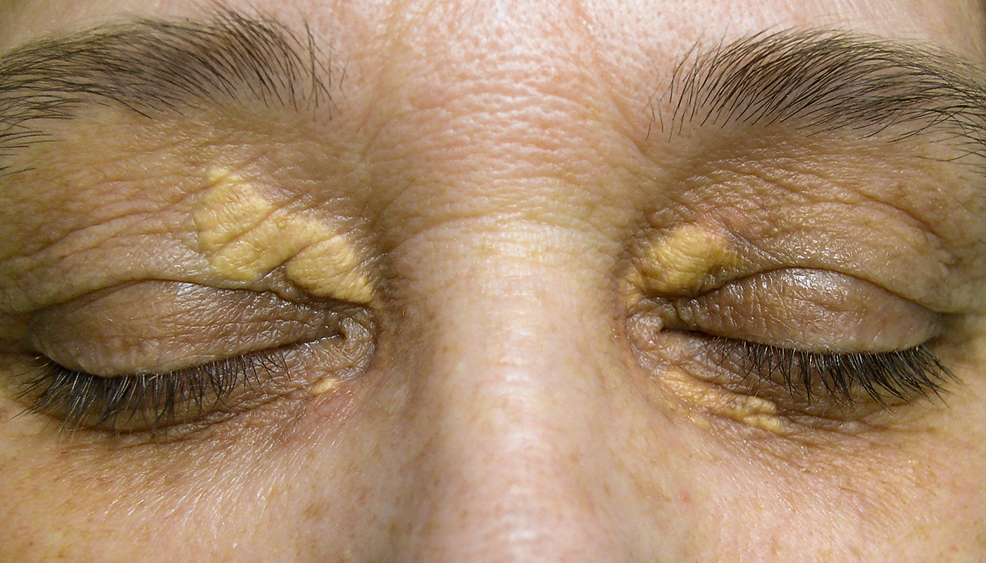 xantelasma in peshawar, xantelasma treatment, eyelid surgery