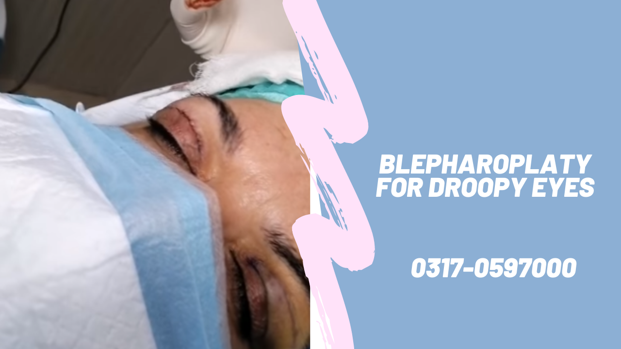 Blepharoplasy for Droopy Eyes