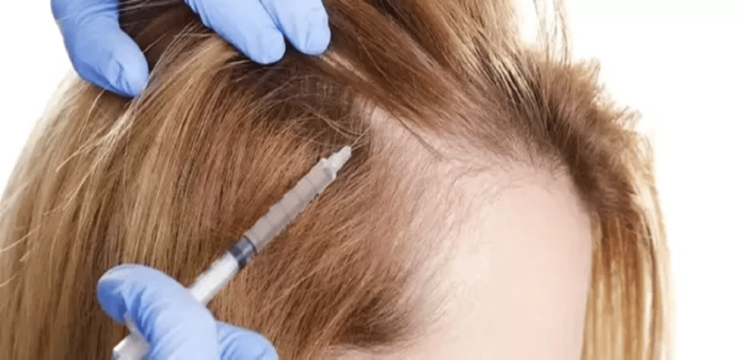 PRP Hair Treatment For Female Hair Loss