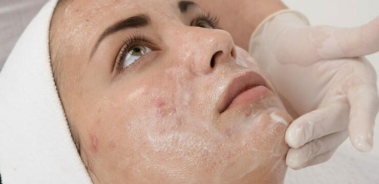 Chemical peels for acne