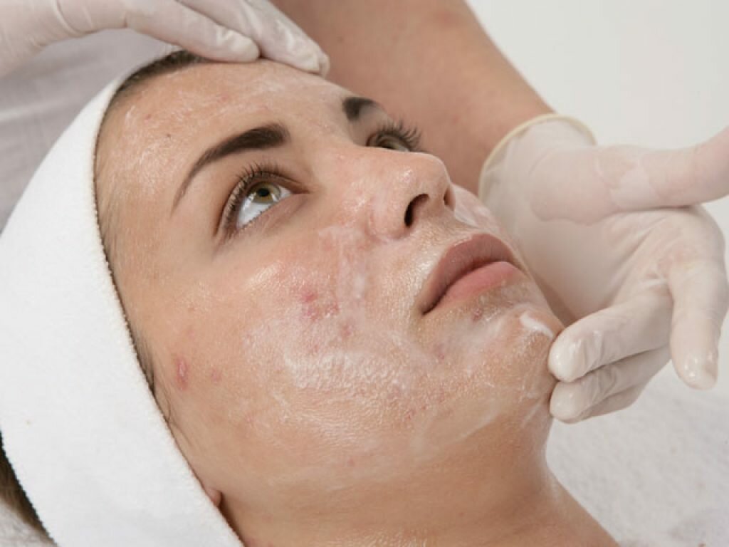 Chemical peels for acne